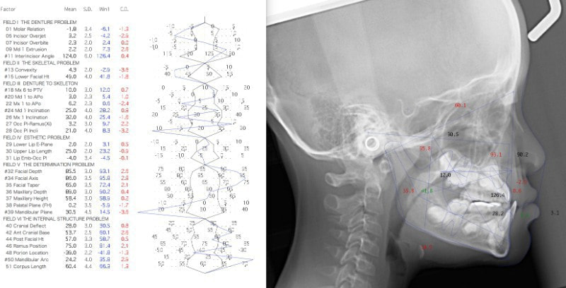 Radiographic Cephalometry 歯科　本　矯正 小児 受け口例3｜秋葉原の矯正専門医院「白石矯正歯科」