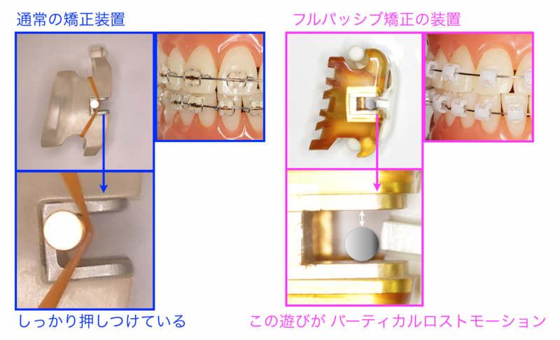 フルパッシブ矯正｜秋葉原の矯正専門医院「白石矯正歯科」