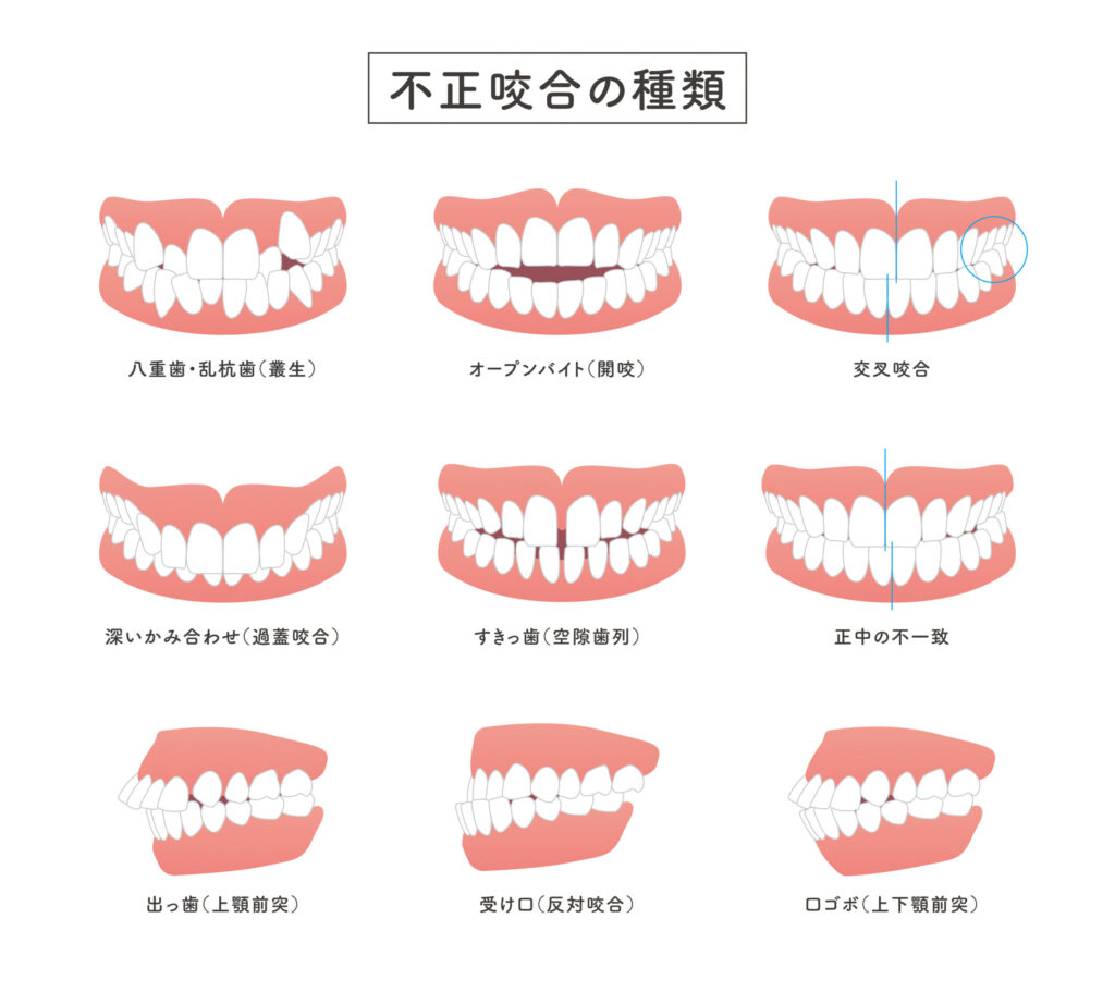 第7回：フルパッシブ矯正はなぜ東洋人向けに作ったのか？ | 白石矯正
